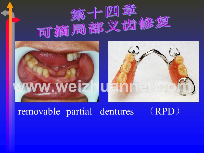 可摘局部义齿修复.ppt_第1页