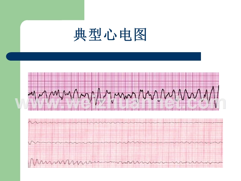 心脏电除颤后患者的护理-李沛珍1.ppt_第3页