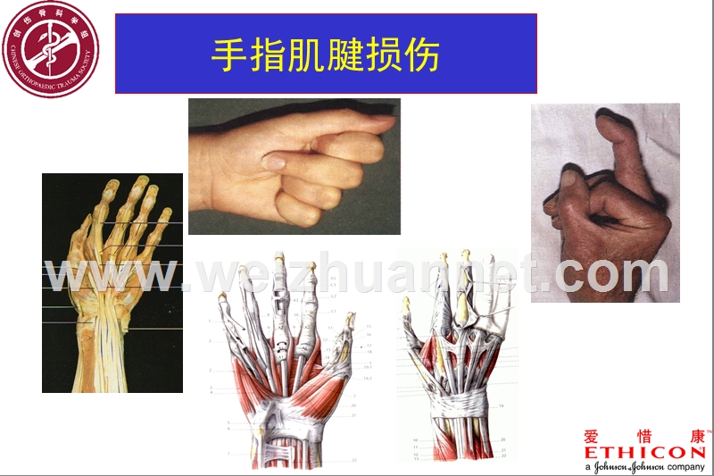 3-手外科肌腱缝合.ppt_第3页