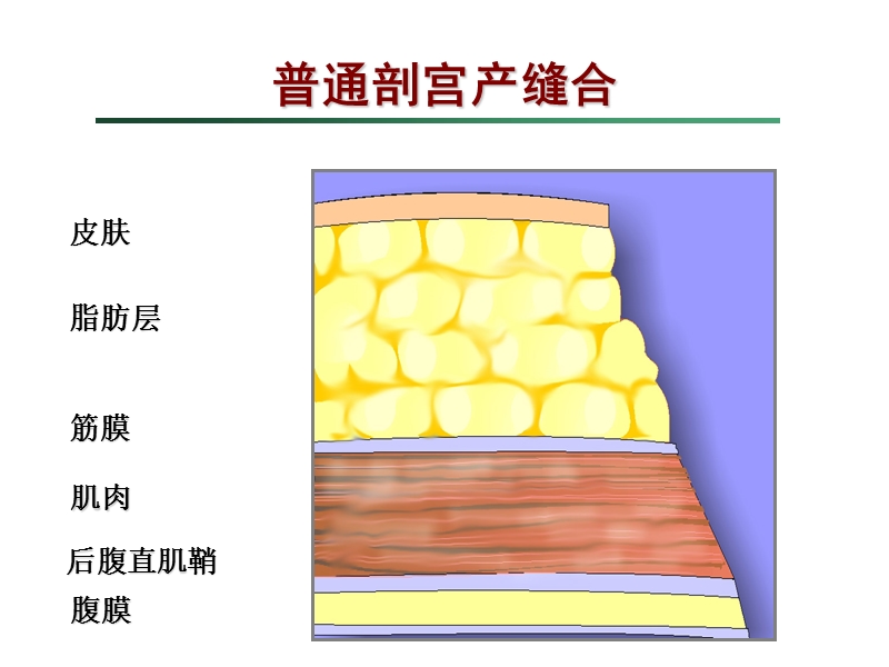 剖宫产手术缝合技术.ppt_第3页