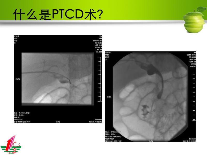 ptcd围手术期护理与观察.ppt_第3页