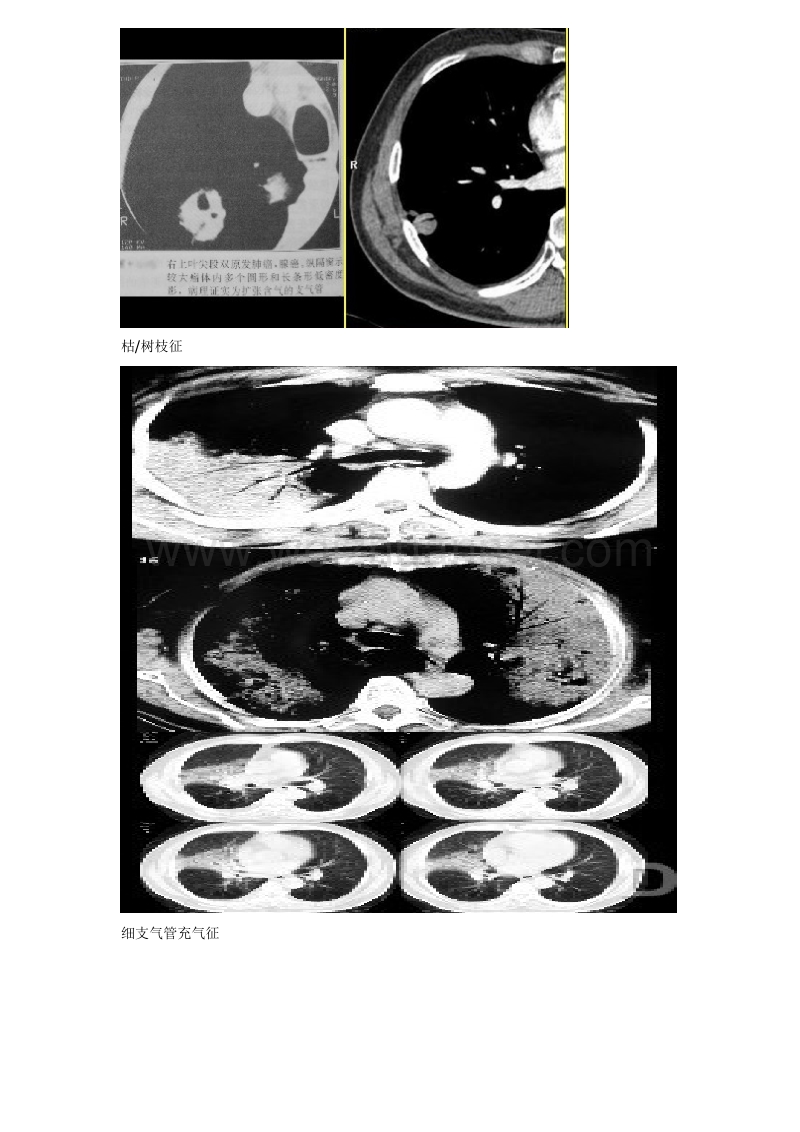 常见胸部ct征象.doc_第2页