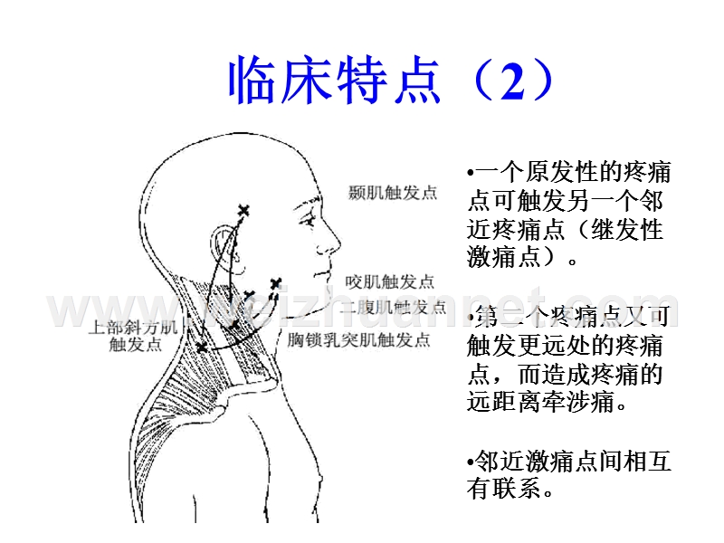 头痛激痛点.ppt_第2页