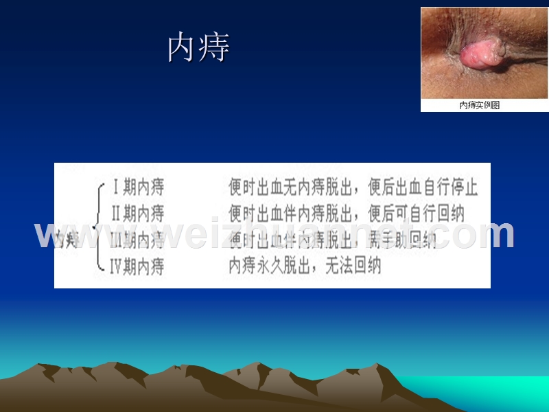 痔疮根治术.ppt_第3页