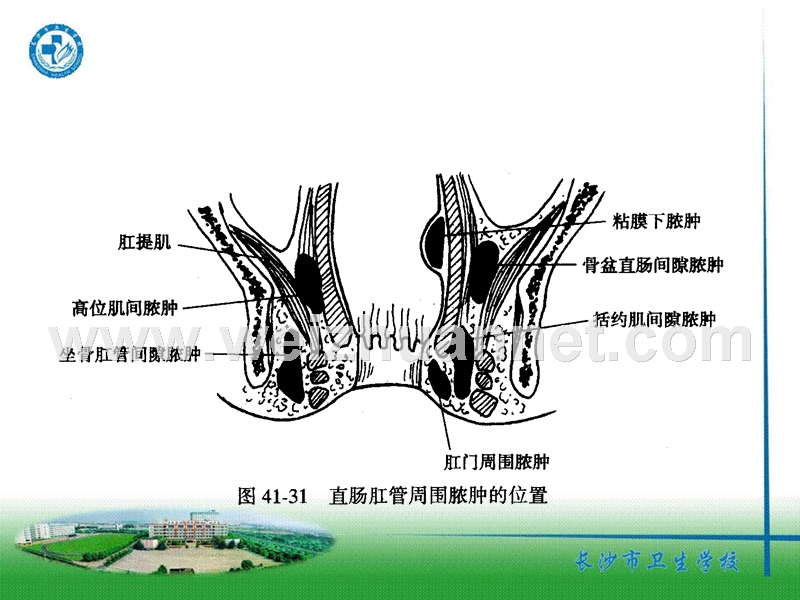 第十二节----直肠肛管周围脓肿病人的.ppt_第2页