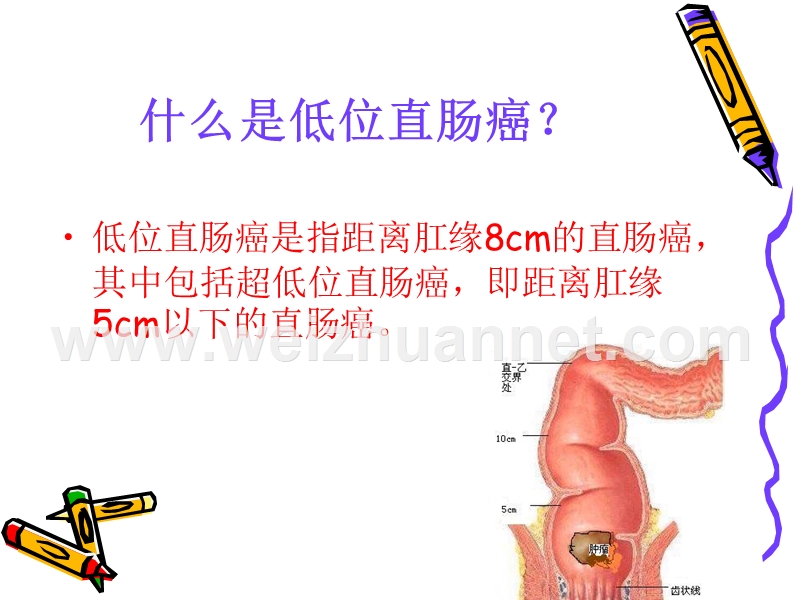 腹腔镜下低位直肠癌.ppt_第2页