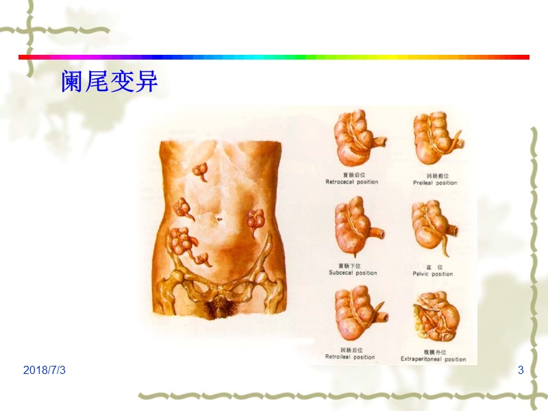 阑尾炎acute-appendicitis.ppt_第3页