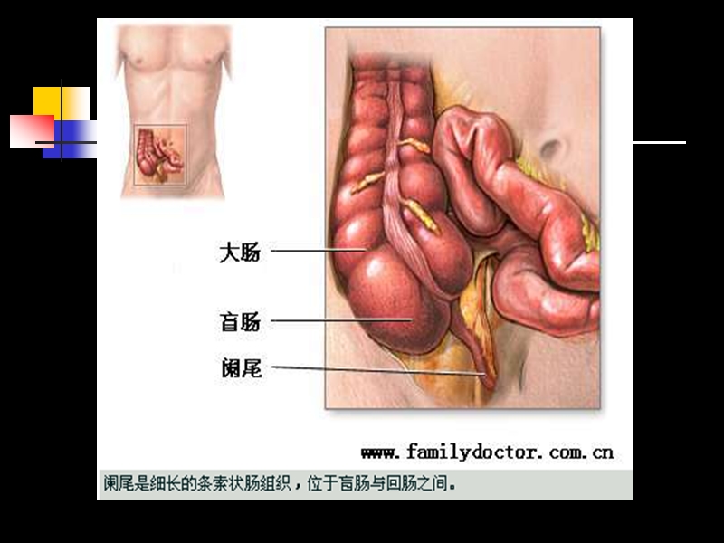 外科护理学阑尾炎病人的护理课件.ppt1.ppt_第3页