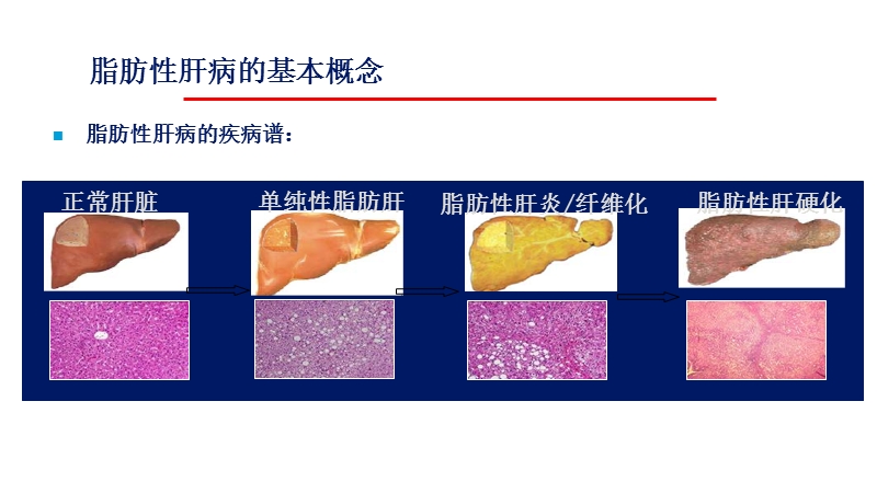 关注脂肪肝.ppt_第3页