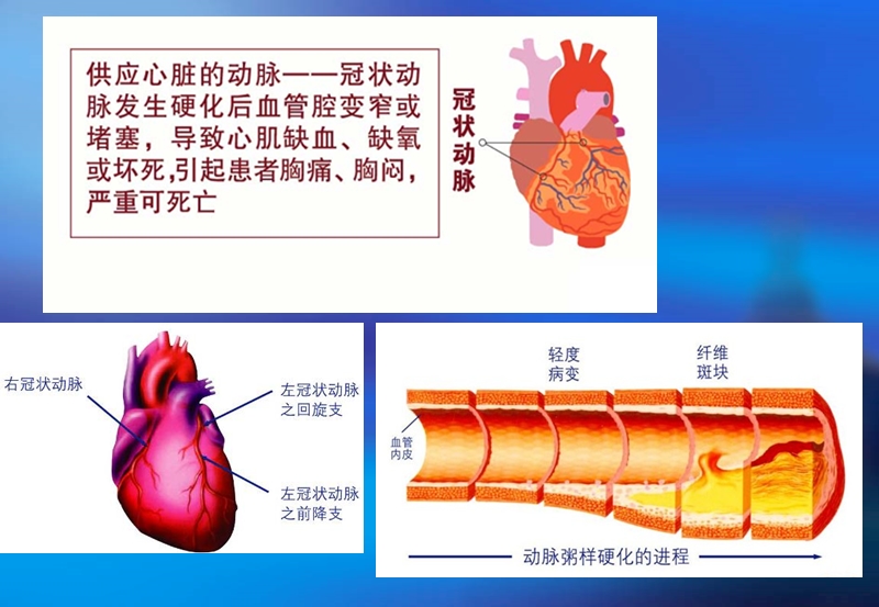 冠心病的康复.ppt_第3页