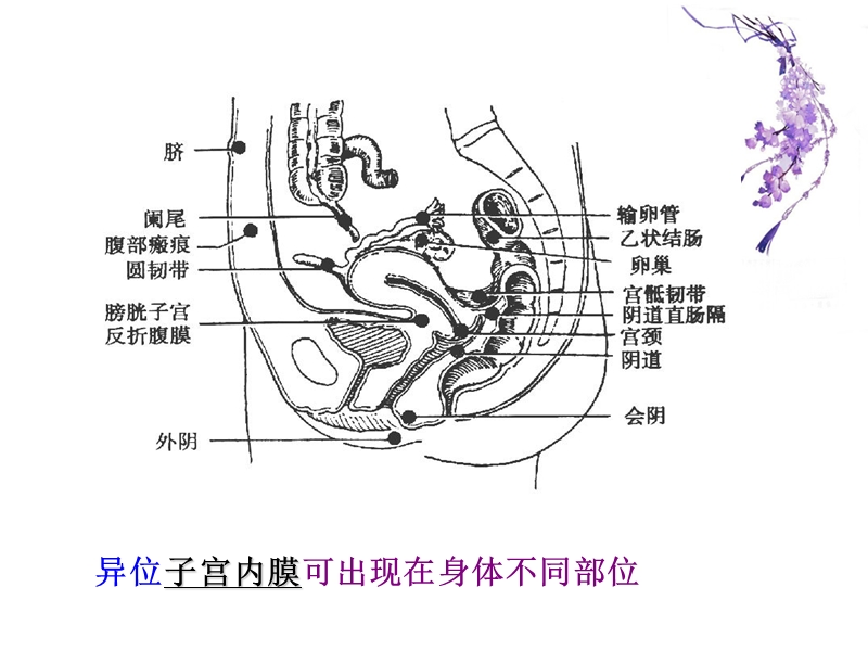 子宫内膜异位性疾病课件.ppt_第2页