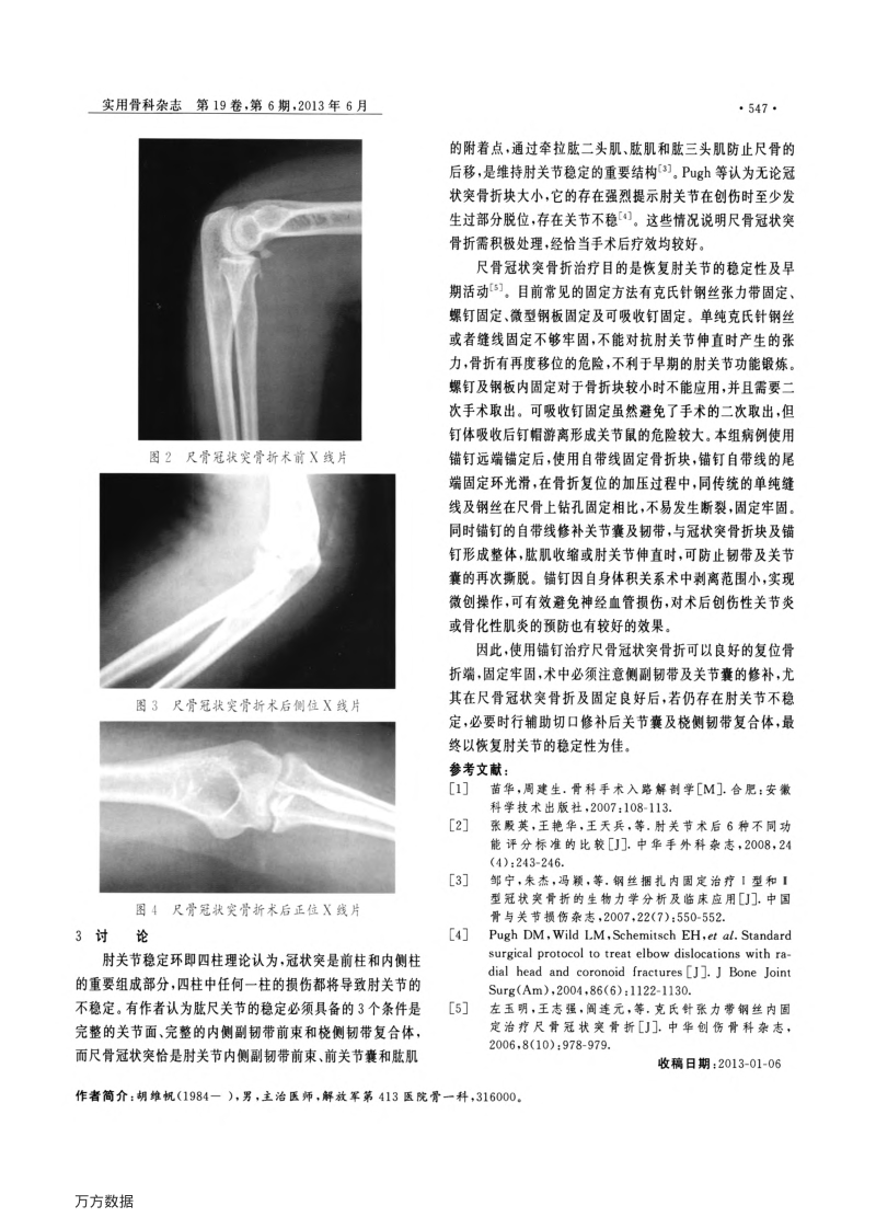 带线锚钉在尺骨冠状突骨折治疗中的应用体会.临床-赵美凤-查找.pdf_第2页