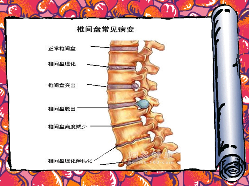 颈椎病的护理查房-元明.ppt_第3页