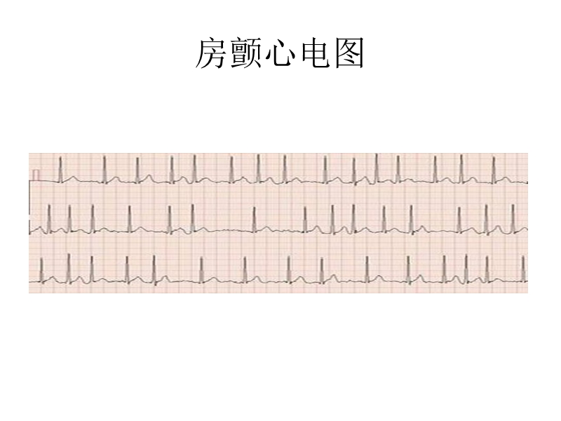 房颤心律.ppt_第2页