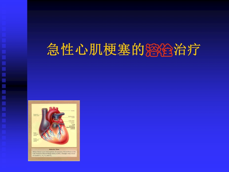 急性心肌梗死溶栓治疗.ppt_第1页