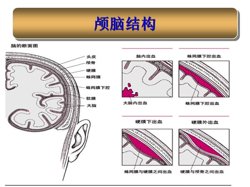 蛛网膜下腔出血护理.ppt_第3页