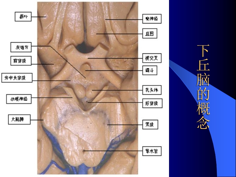 下丘脑解剖颅咽管瘤切除.ppt_第2页