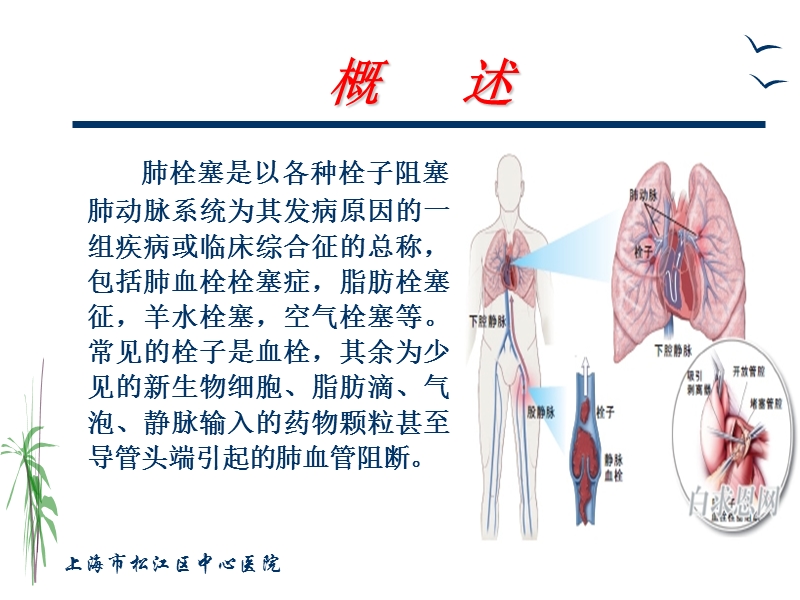 肺栓塞的治疗与护理.ppt_第2页