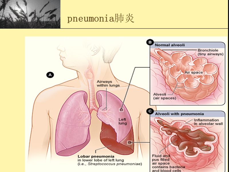 肺炎的护理(带案例).ppt_第3页