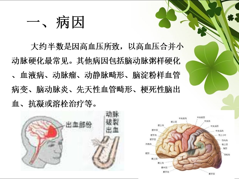 脑出血护理(1).ppt_第3页