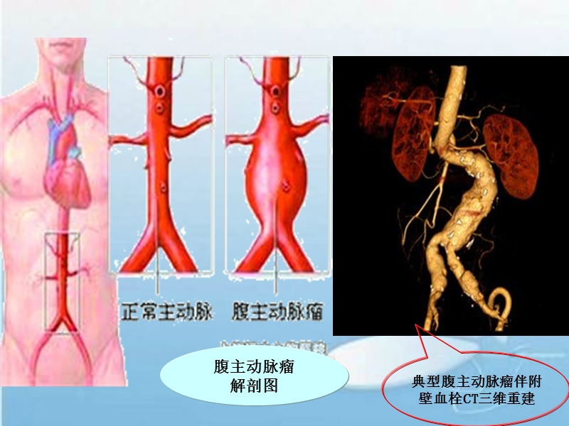 腹主动脉瘤.ppt_第3页