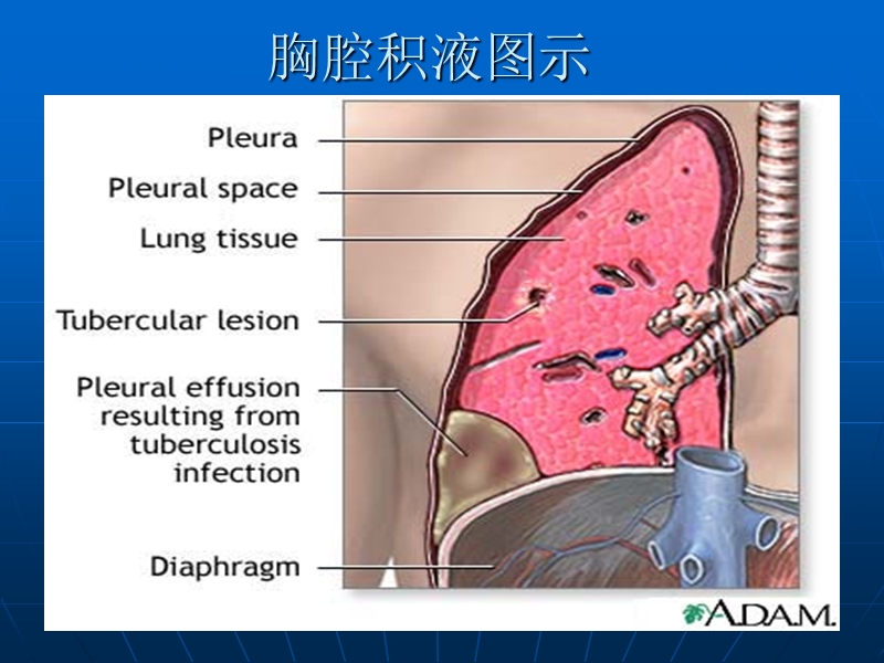 胸膜腔穿刺术.ppt_第3页