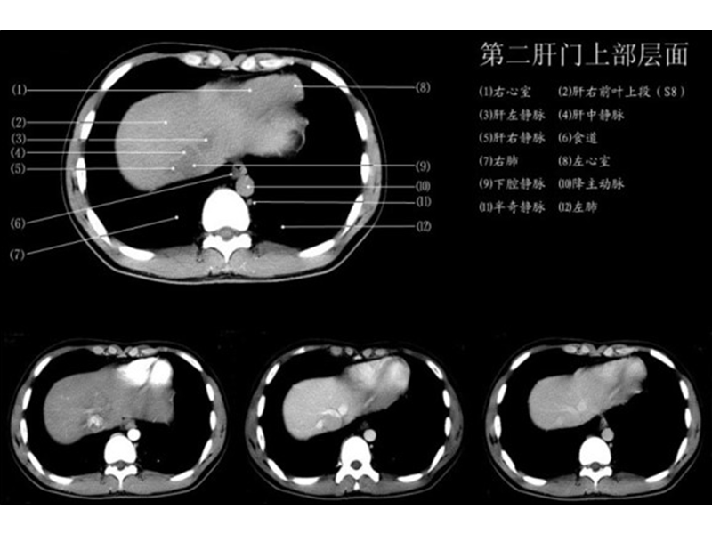 上腹部各层面ct.ppt_第3页