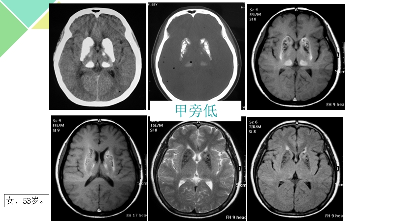 甲状旁腺功能减退症.pptx_第2页