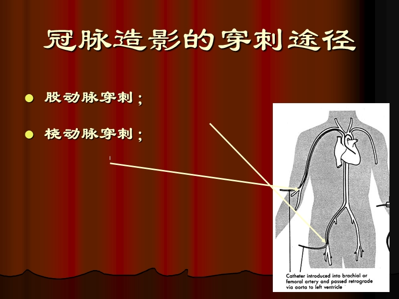 经股动脉冠脉造影术的术前术后护理.ppt_第3页