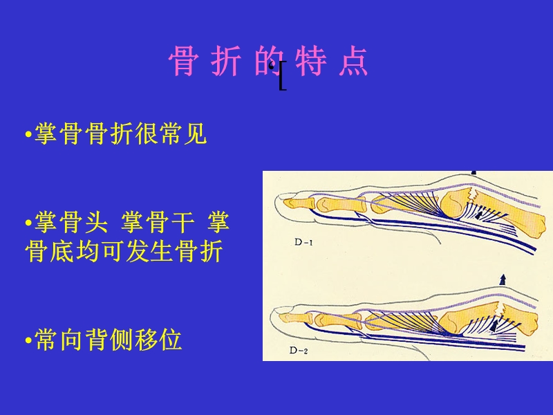 掌骨骨折内固定.ppt_第3页