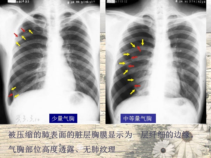 呼吸系统常见疾病影像学表现4.ppt_第3页