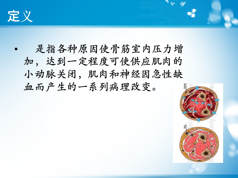 骨筋膜室综合征观察与护理.ppt_第2页