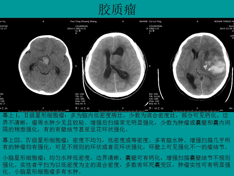 典型病例影像表现.ppt_第2页