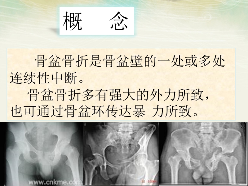 骨盆骨折病人的护理.ppt_第3页