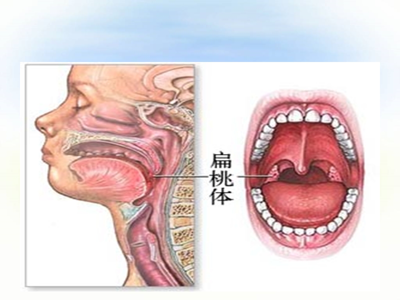 扁桃体手术配合.ppt_第3页