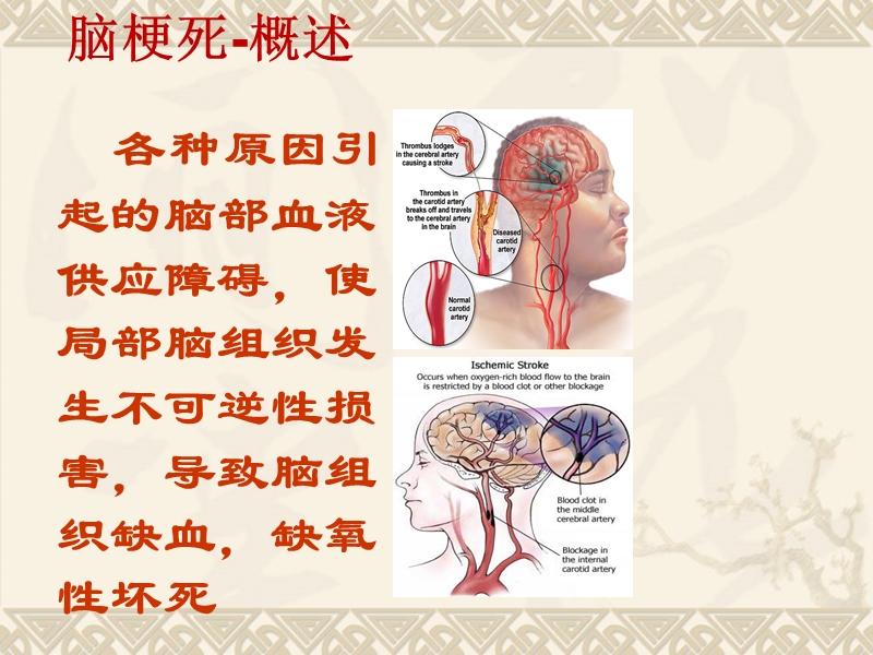 最经典的脑梗死临床表现及治疗.ppt_第2页