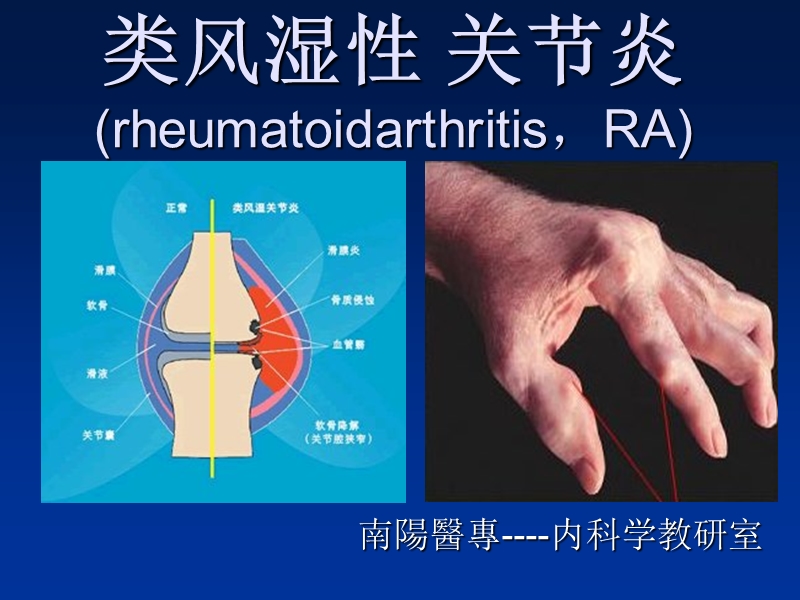 35类风湿性关节炎.ppt_第1页