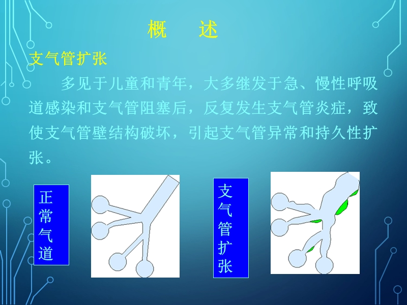 支气管扩张伴咯血.ppt_第2页