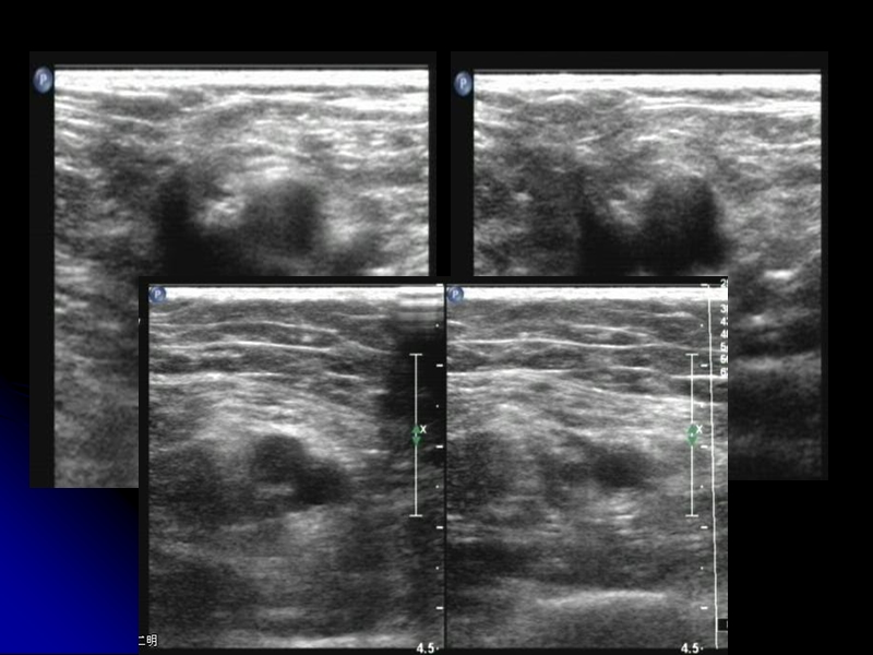 上下肢动静脉的超声检查2011.ppt_第3页