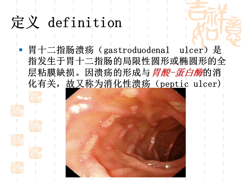 胃十二指肠溃疡.ppt_第2页