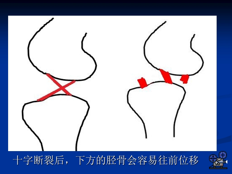 犬十字韧带断裂诊断与手术研究进展.ppt_第3页