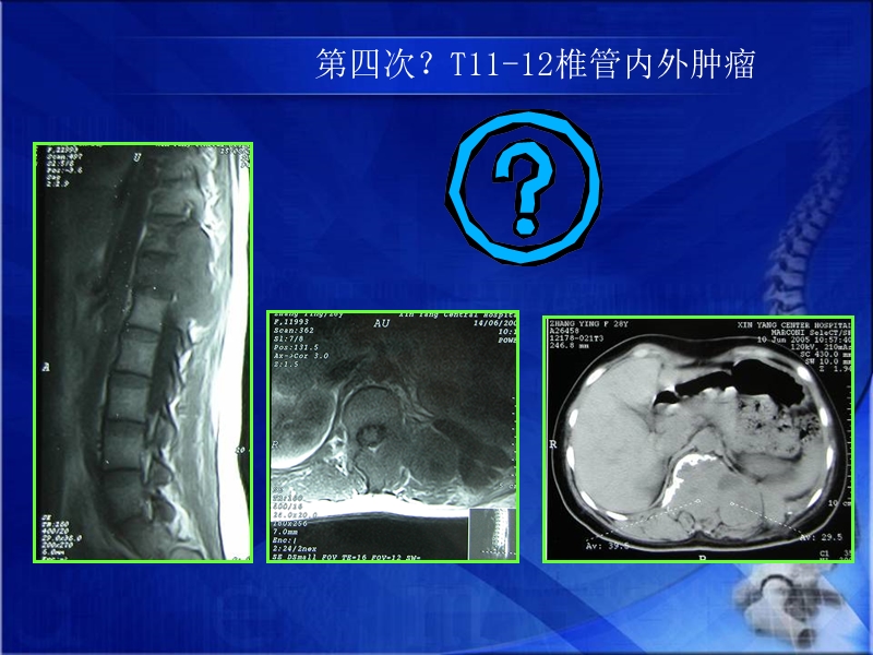 胸椎哑铃型肿瘤手术策略.ppt_第3页