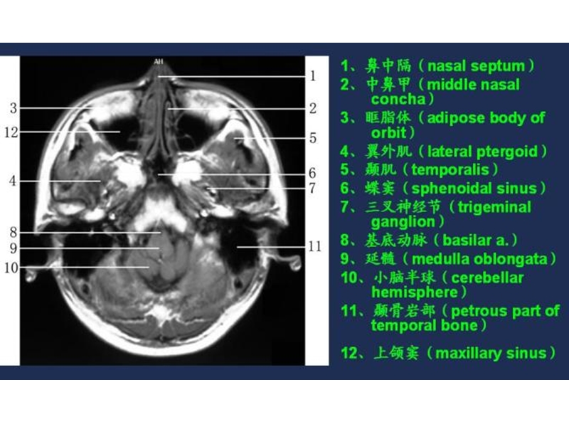 mri常用解剖.ppt_第1页