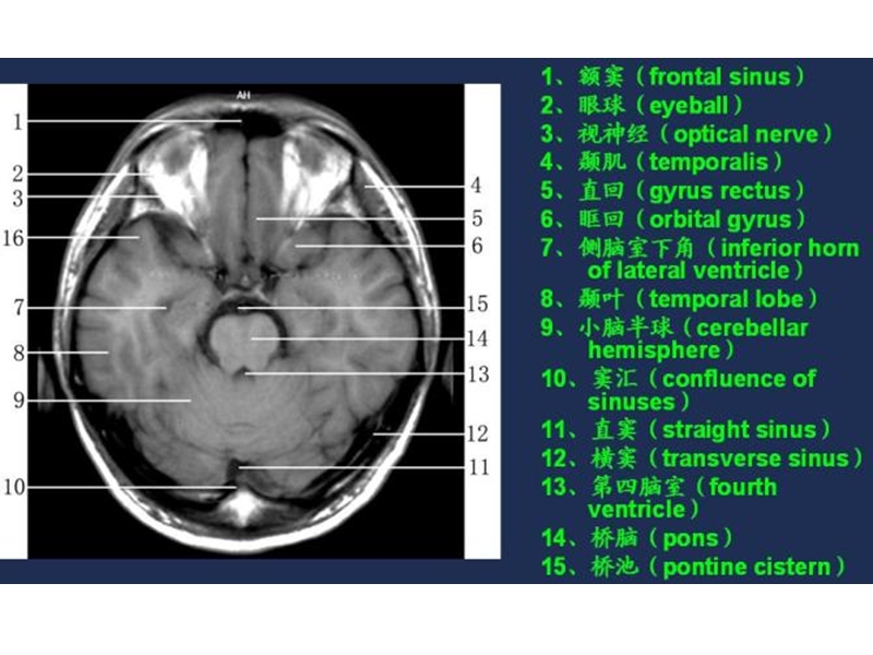 mri常用解剖.ppt_第3页