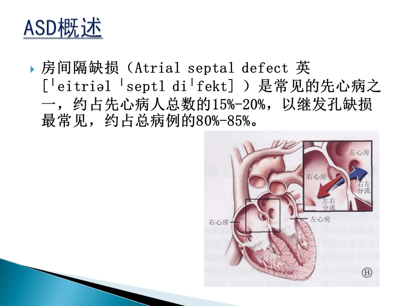 房间隔缺损封堵术的护理.ppt_第3页