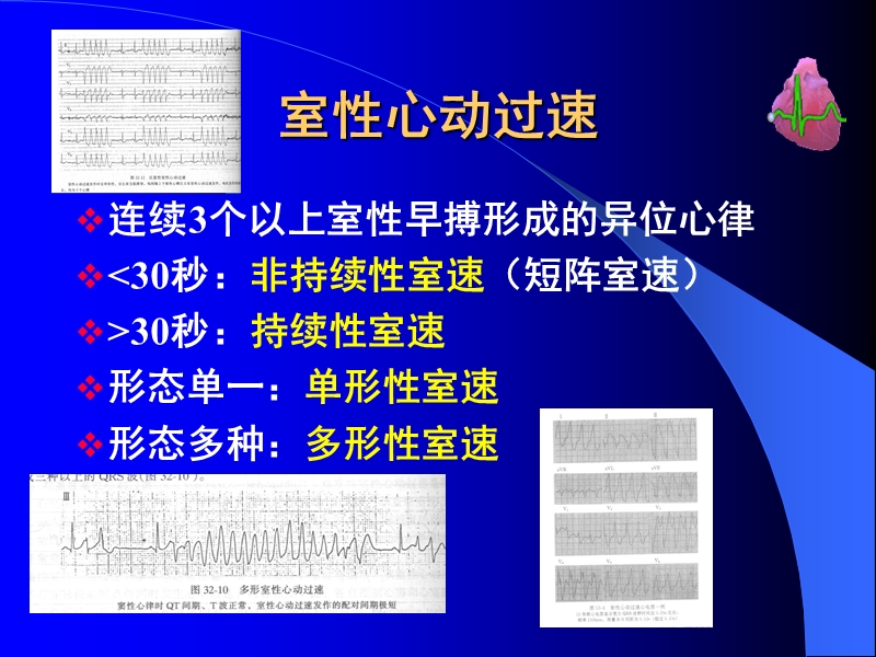 室速心电图.ppt_第3页