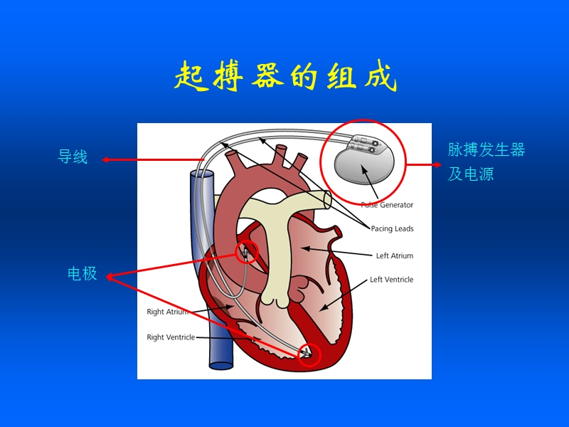 心外_临时起搏器.ppt_第3页