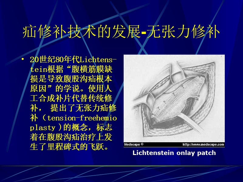 腹膜前间隙疝修补术.ppt_第2页