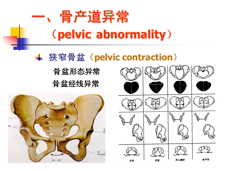 产道异常.ppt_第3页