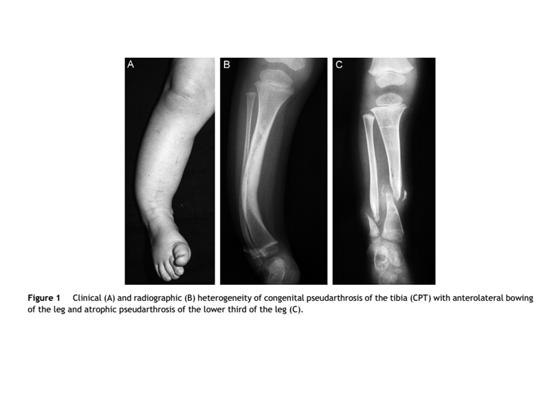 先天性胫骨假关节.ppt_第1页